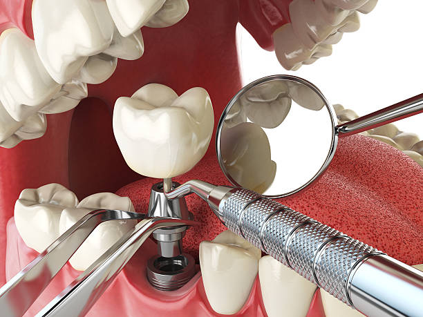 Best Chipped Tooth Repair Near Me  in Lake Mohegan, NY